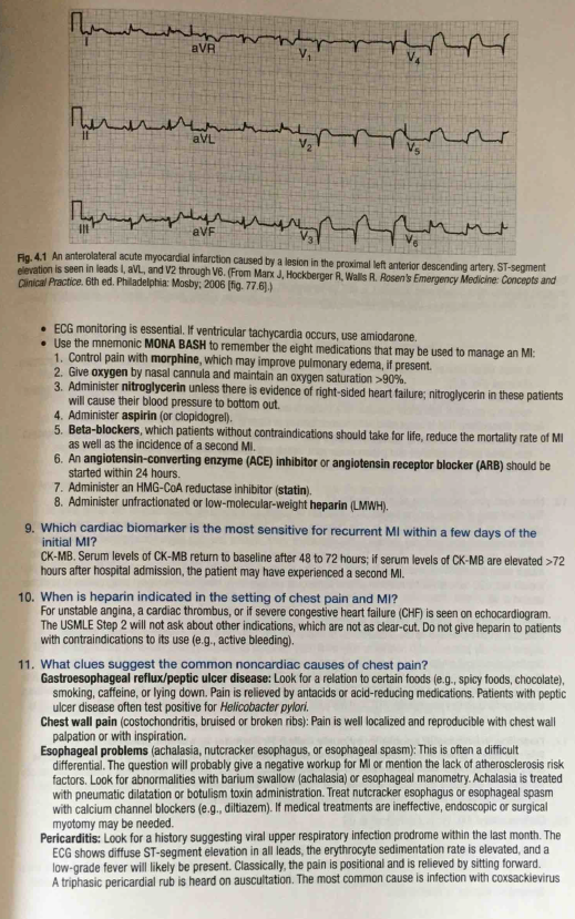 MI questions USMLE2 secrets 2